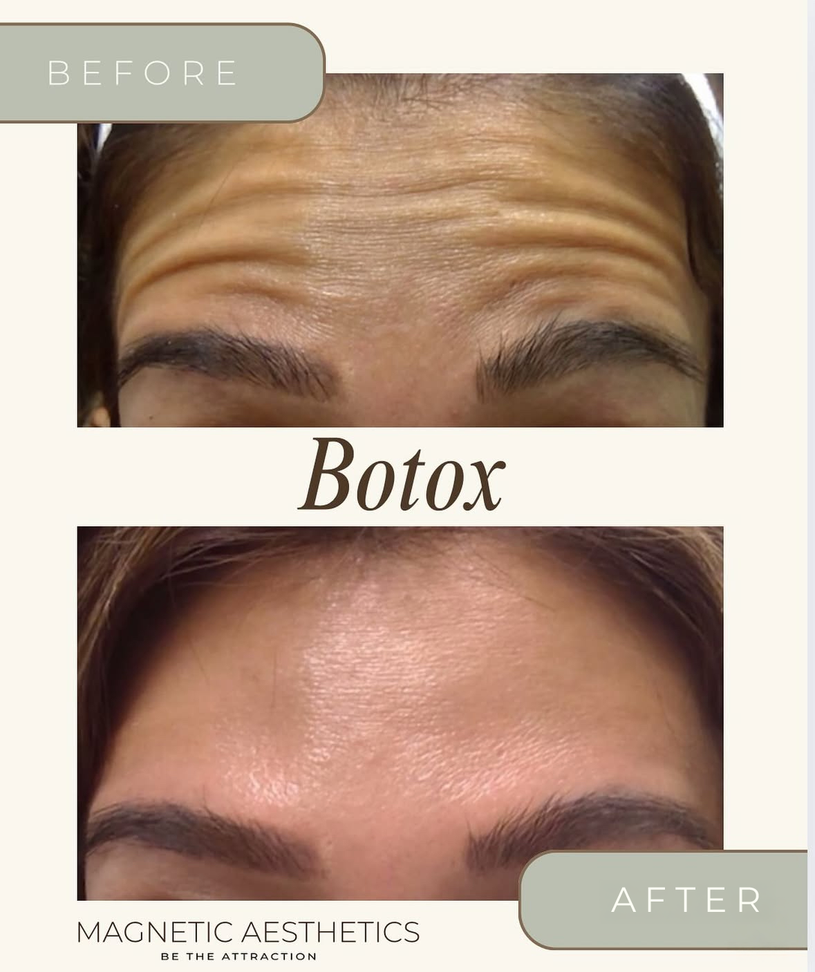 Botox in Reno, NV (2)