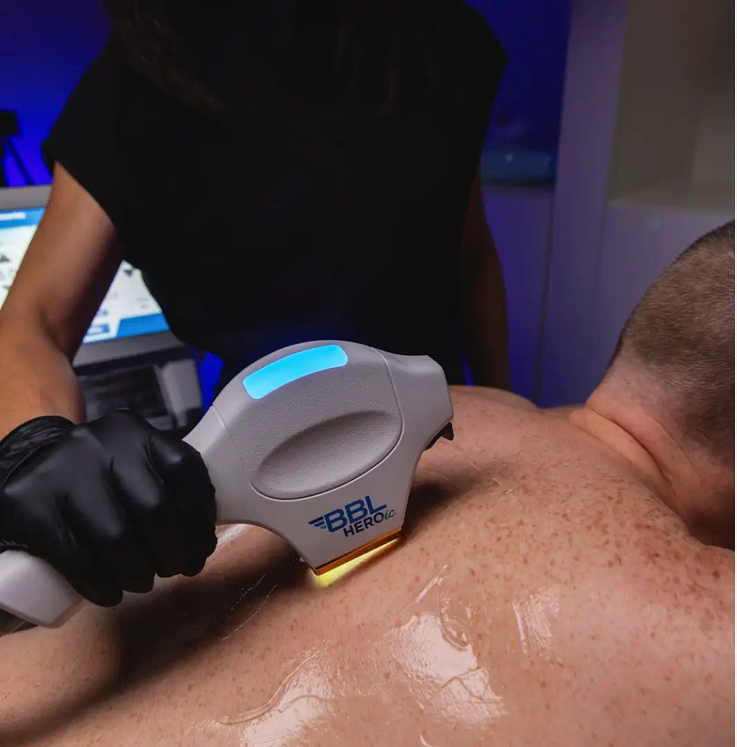 Man receiving Sciton Moxi Laser at his back | Magnetic Aesthetics | Reno, NV